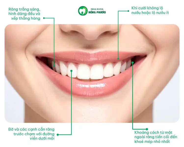 4 tiêu chuẩn nụ cười duyên