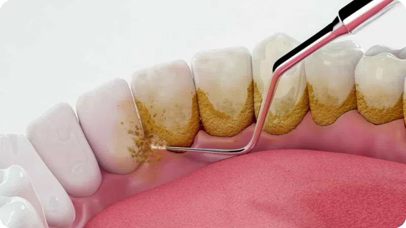 Dịch vụ cạo vôi răng