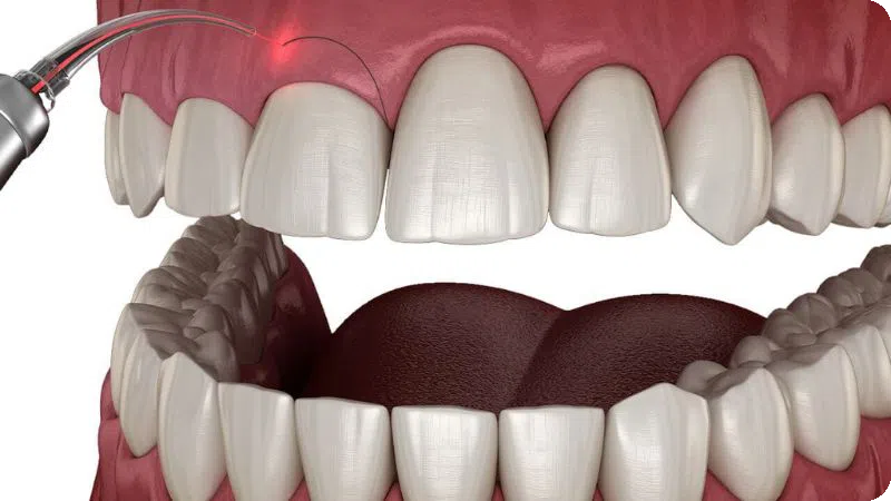 điều trị cười hở lợi