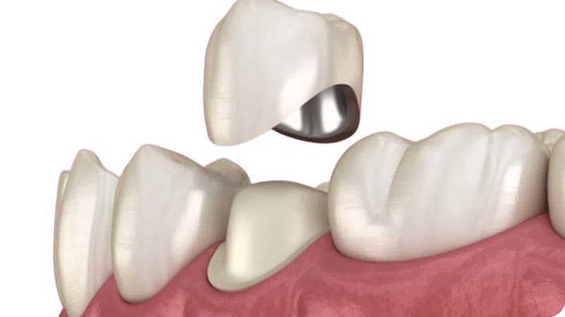 BỌC RĂNG SỨ KIM LOẠI