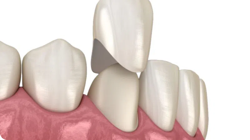 BỌC RĂNG TOÀN SỨ