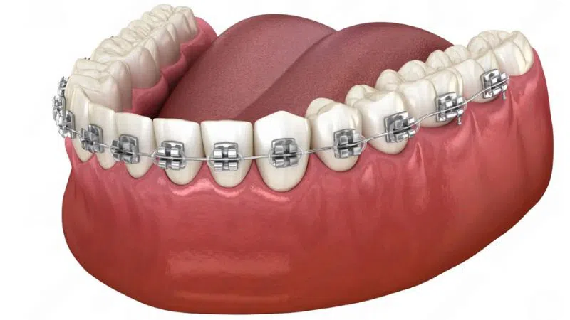 Dịch vụ niềng răng mắc cài