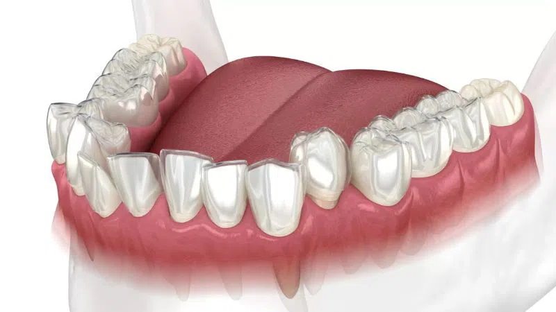 dịch vụ niềng răng khay trong suốt