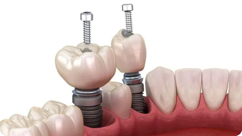 Trồng răng Implant đơn lẻ