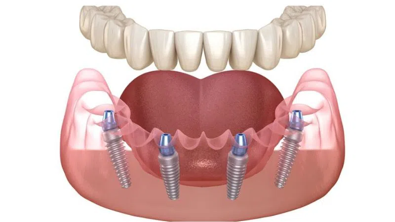 trồng răng Implant toàn hàm