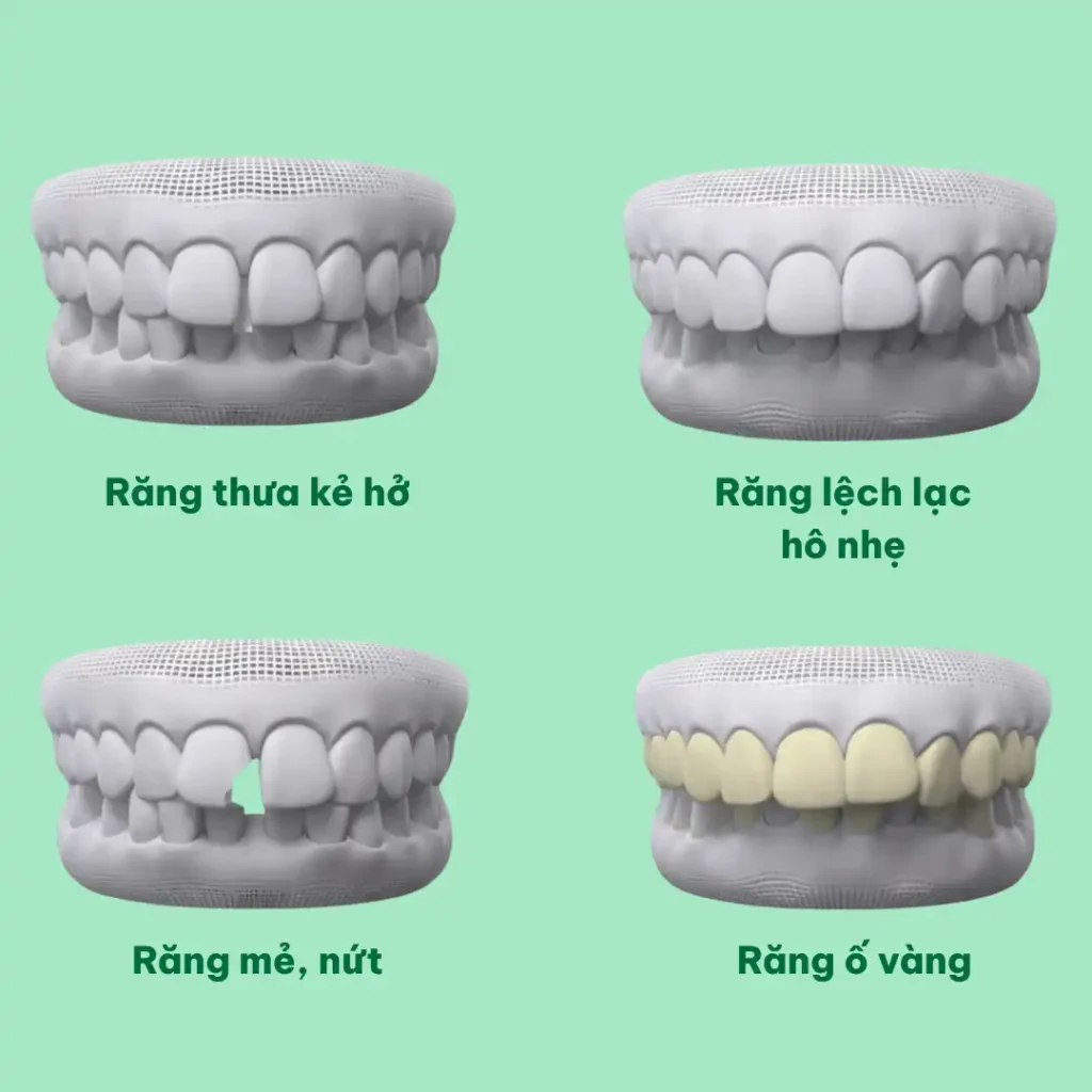 ai nên dán sứ veneer