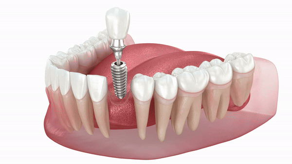 Trồng răng Implant