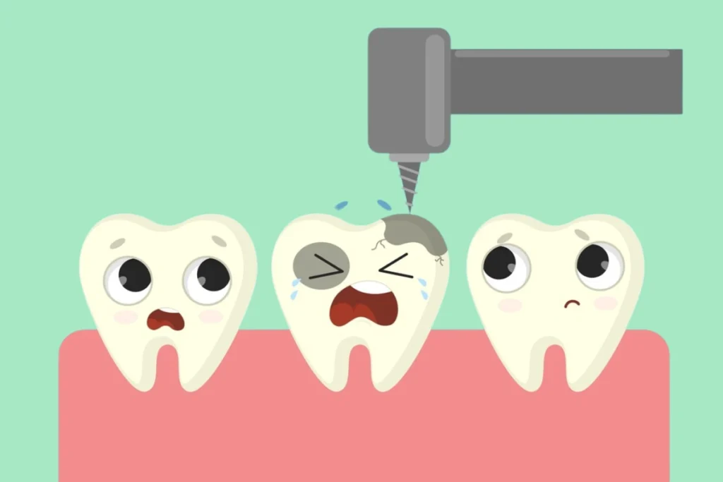 điều trị tủy răng sữa