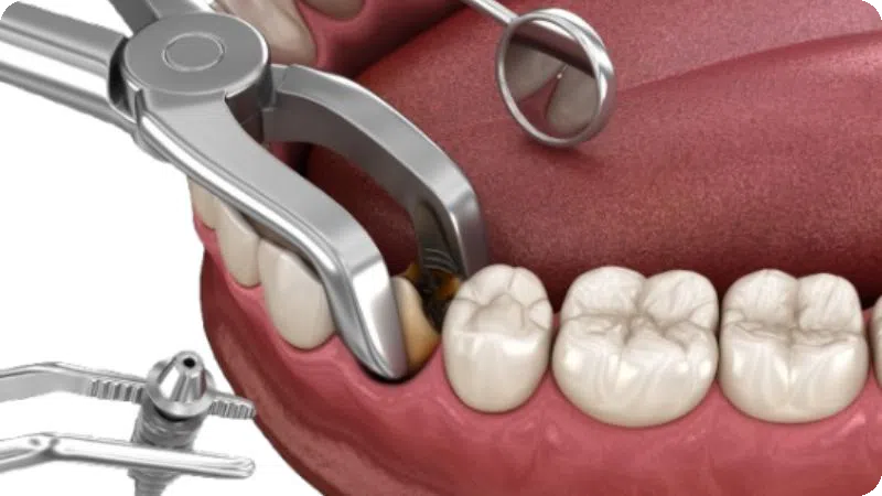 nhổ răng