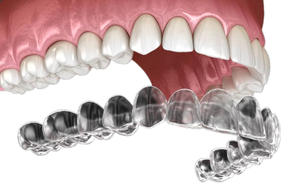 niềng răng trong suốt invisalign