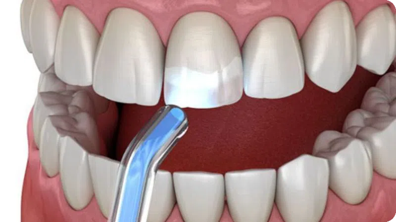 dịch vụ Trám răng