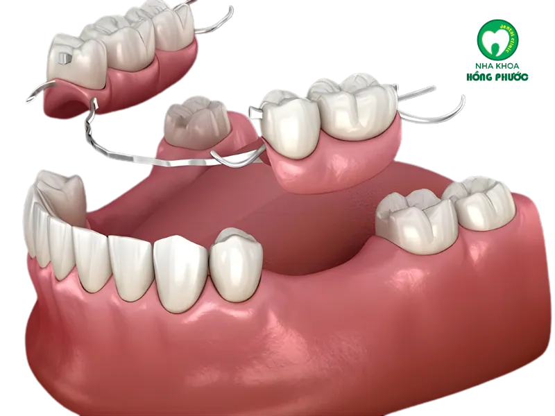 phục hình tháo lắp