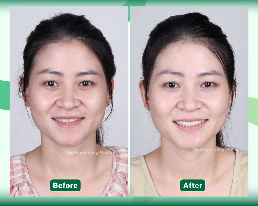 KH Huỳnh B DÁN SỨ VENEER tại Nha khoa Hồng Phước Tây Ninh