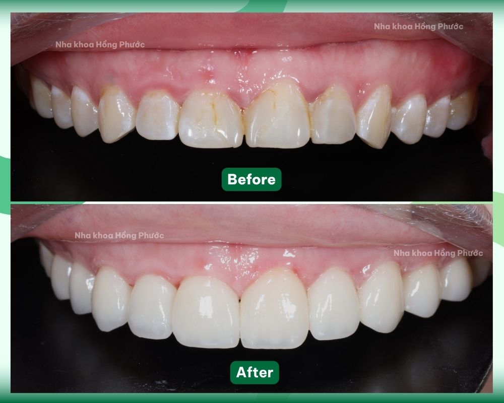 KH Huỳnh B DÁN SỨ VENEER tại Nha khoa Hồng Phước Tây Ninh