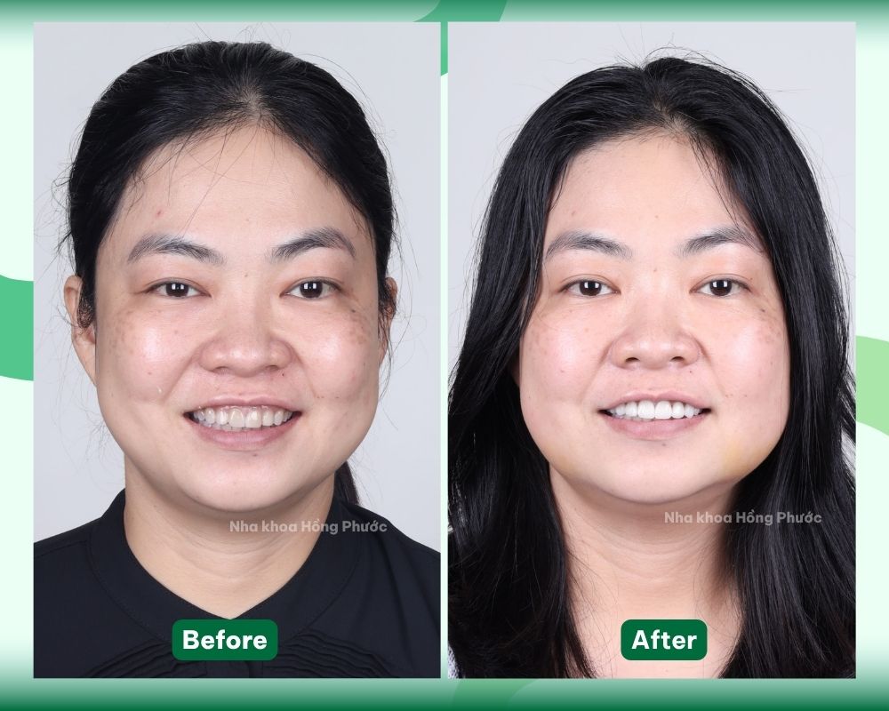 KH Nguyen Thi A DÁN SỨ VENEER TẠI TÂY NINH