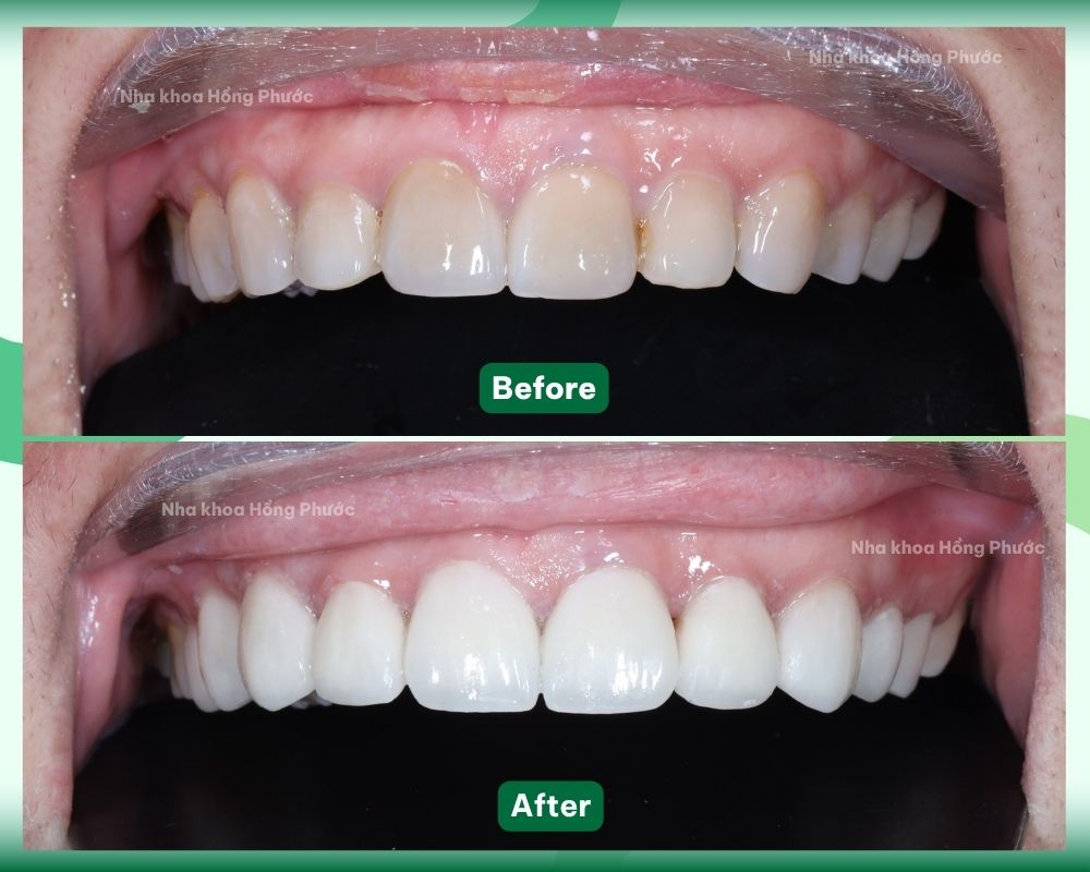 KH Nguyen Thi A DÁN SỨ VENEER TẠI TÂY NINH