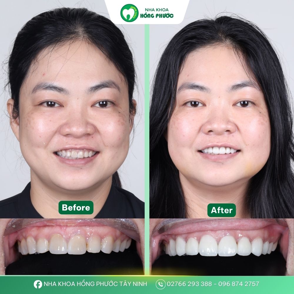 Dán răng sứ Veneer