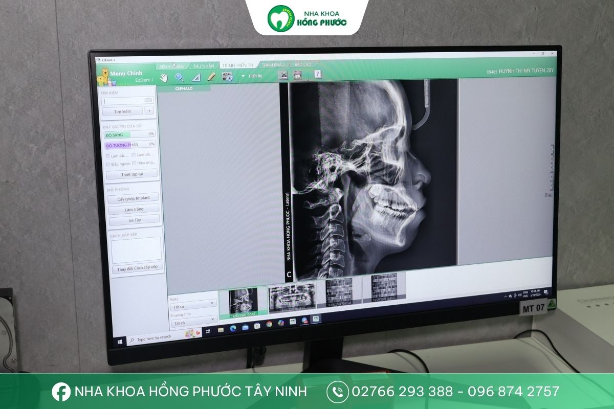 Dữ liệu từ máy chụp CT Cone Beam 3D