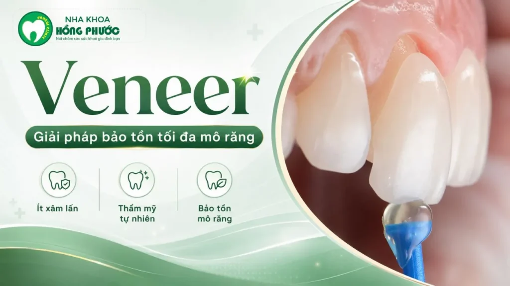 Veneer giải pháp bảo tồn tối đa mô răng