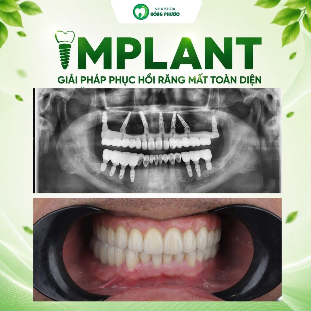 Các ca Implant lâm sàng tại Nha khoa Hồng Phước Tây Ninh