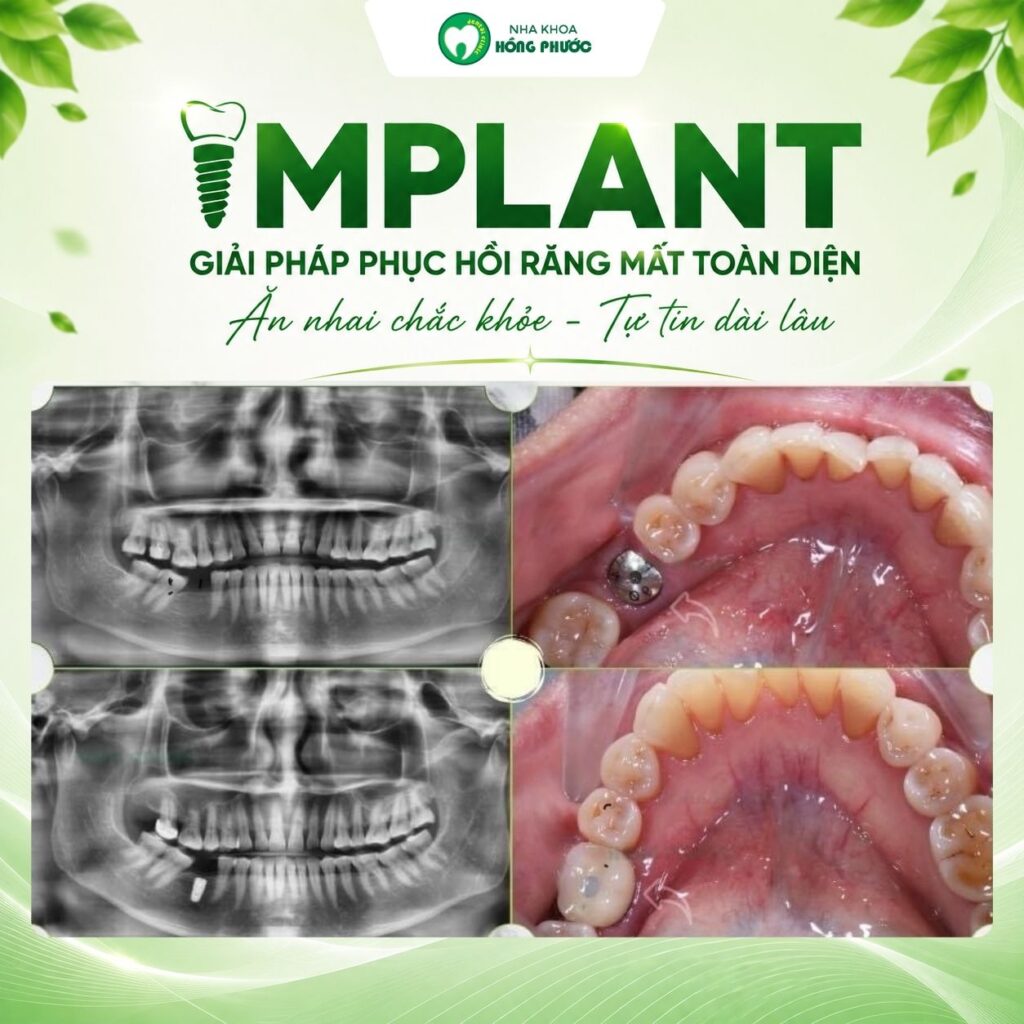 Các ca Implant lâm sàng tại Nha khoa Hồng Phước Tây Ninh