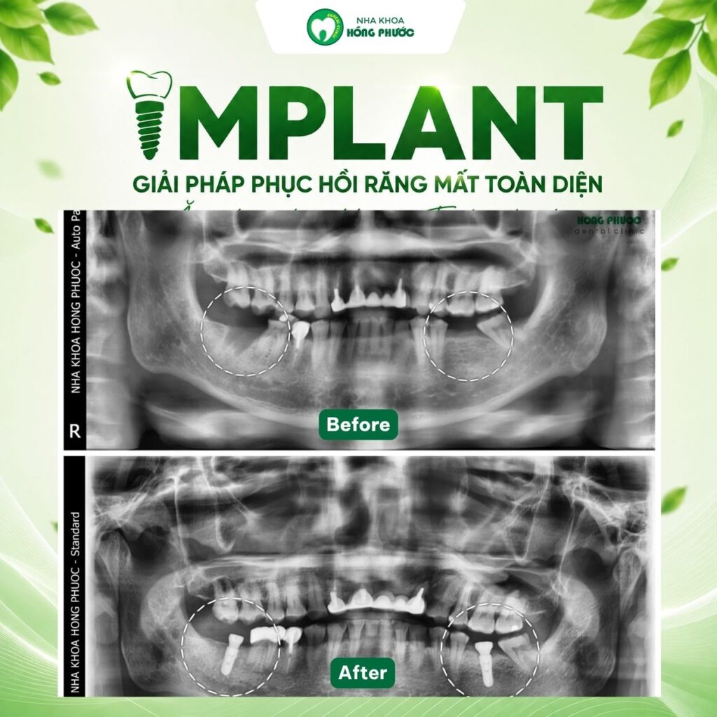 Các ca Implant lâm sàng tại Nha khoa Hồng Phước Tây Ninh