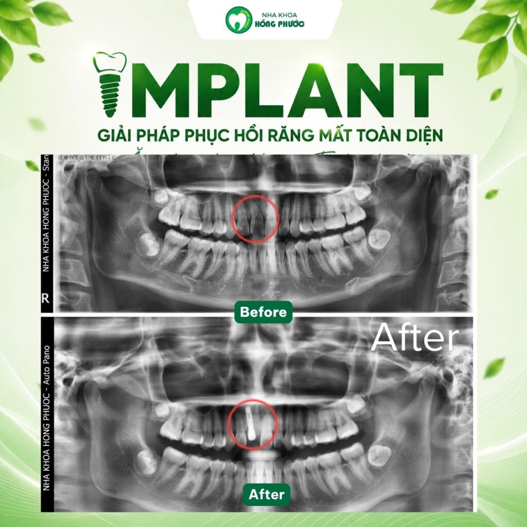 Các ca Implant lâm sàng tại Nha khoa Hồng Phước Tây Ninh