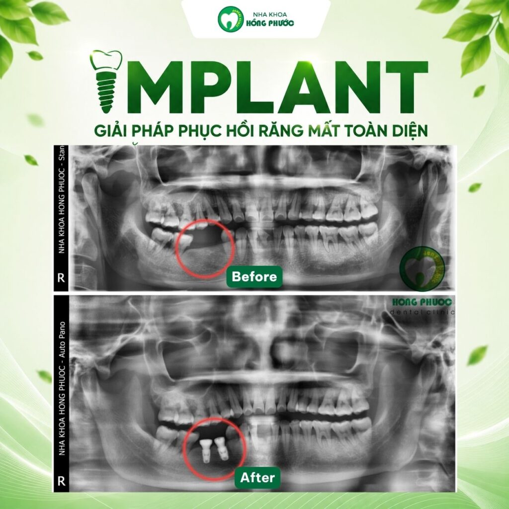 Các ca Implant lâm sàng tại Nha khoa Hồng Phước Tây Ninh