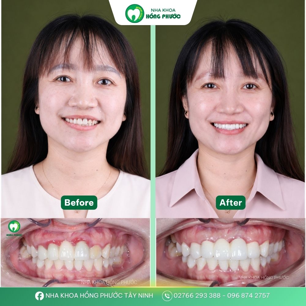 Khách hàng bọc răng sứ tại Nha khoa Hồng Phước