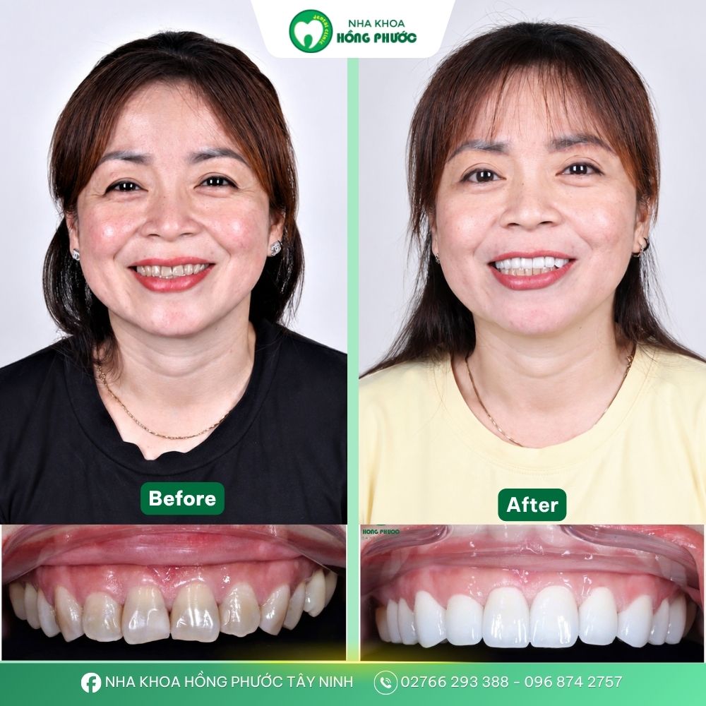 Khách hàng bọc răng sứ tại Nha khoa Hồng Phước