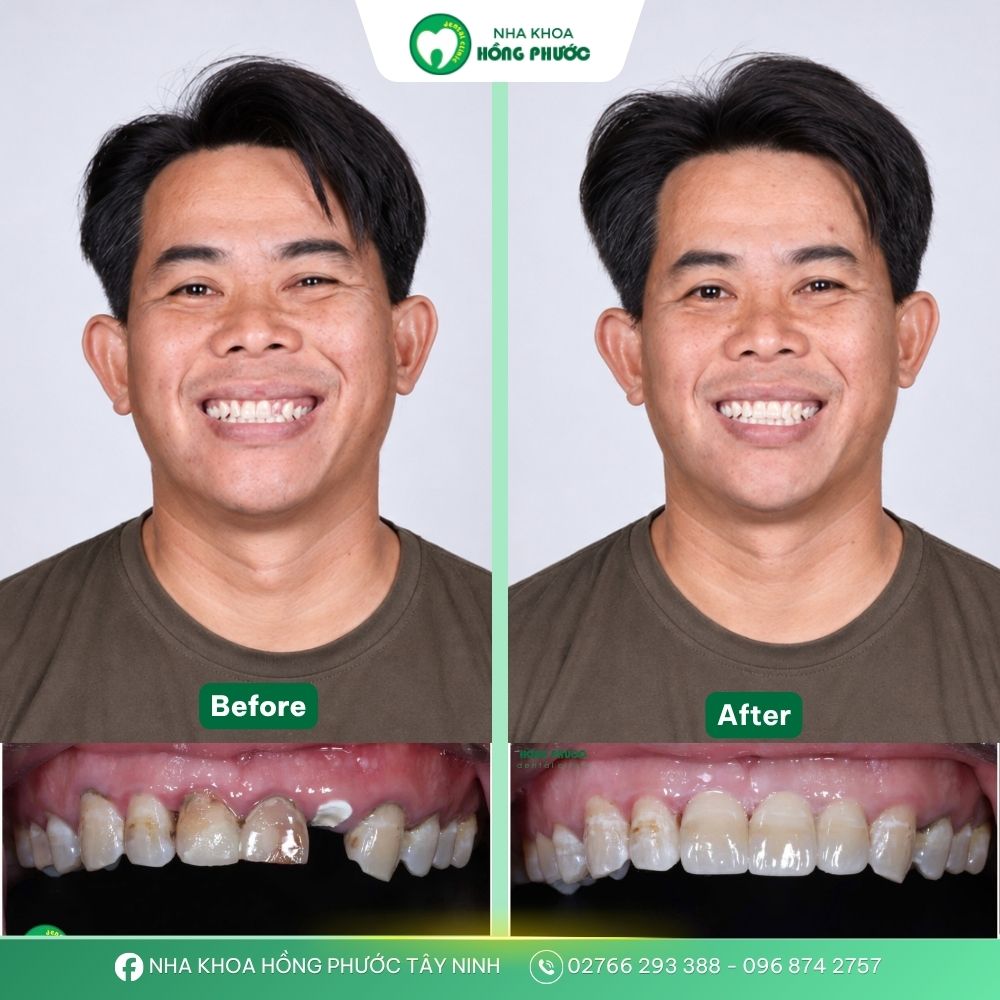 Khách hàng bọc răng sứ tại Nha khoa Hồng Phước