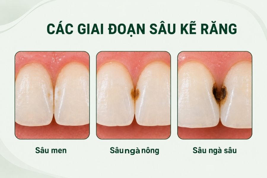 Dau hieu nhan biet rang bi sau ke qua su thay doi mau sac va e buot