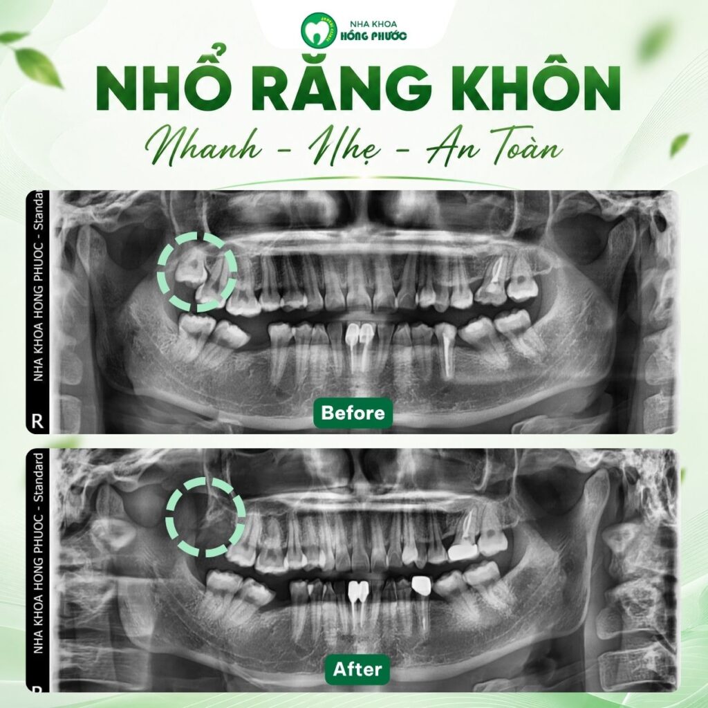 Anh T. Quốc Bảo - Nhổ răng khôn